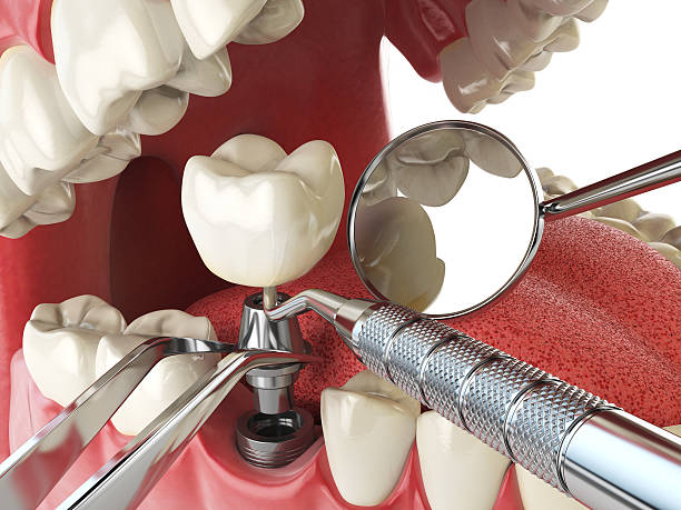 Best Urgent Care for Lost Fillings or Crowns in Bensville, MD